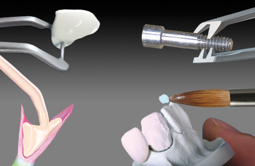 IPD Abutments