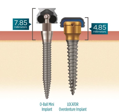 implant2