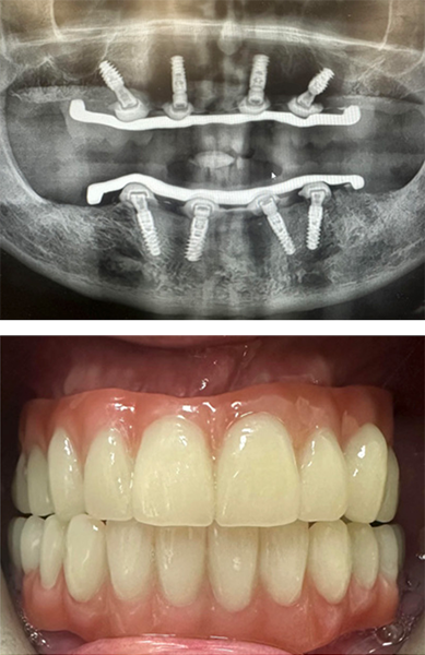 LOCATOR ANGLED ABUTMENTS
